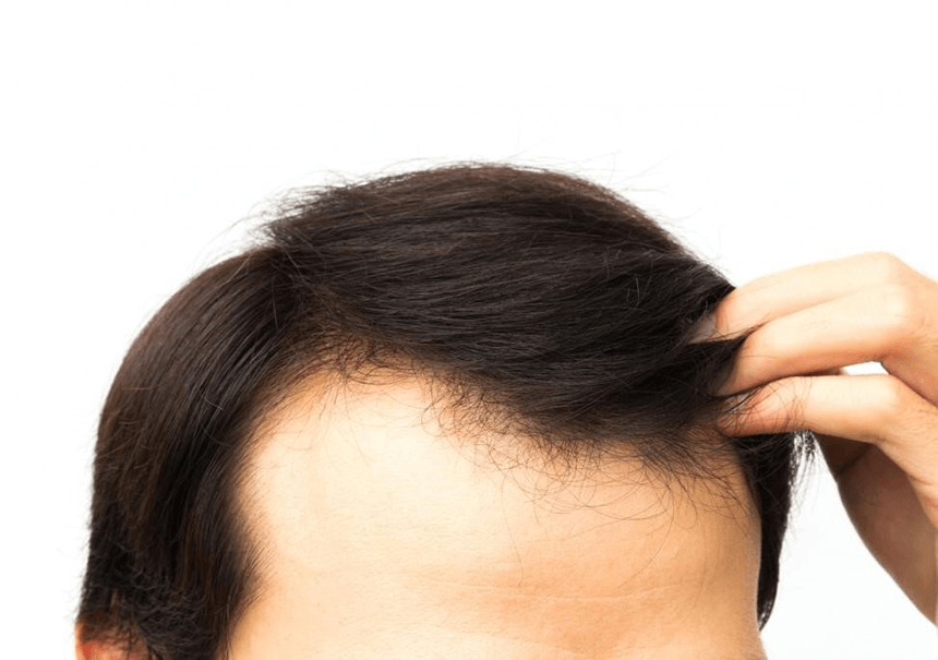 Hair Loss in Men