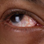 Pink Eye Causes and Treatments