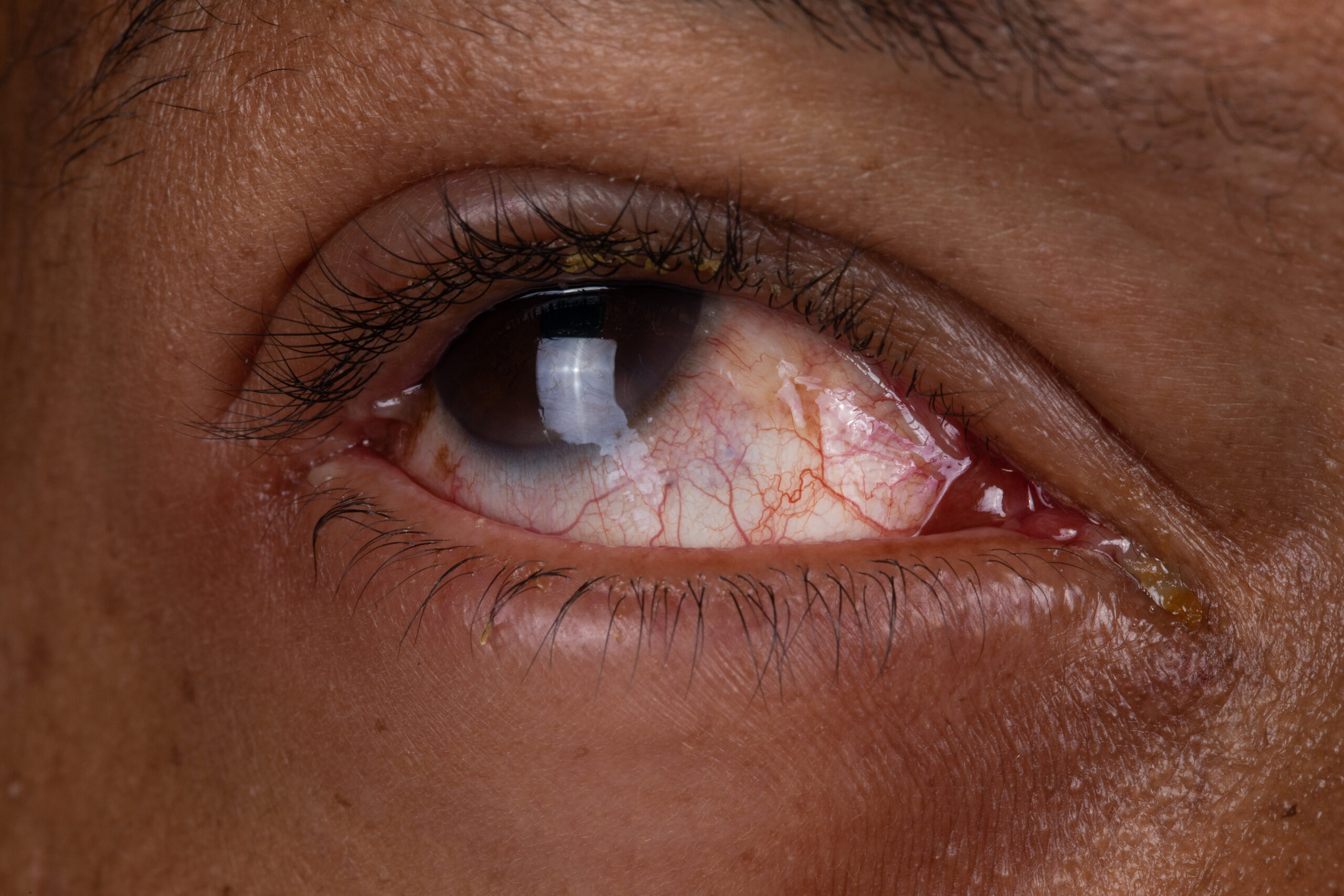 Pink Eye Causes and Treatments