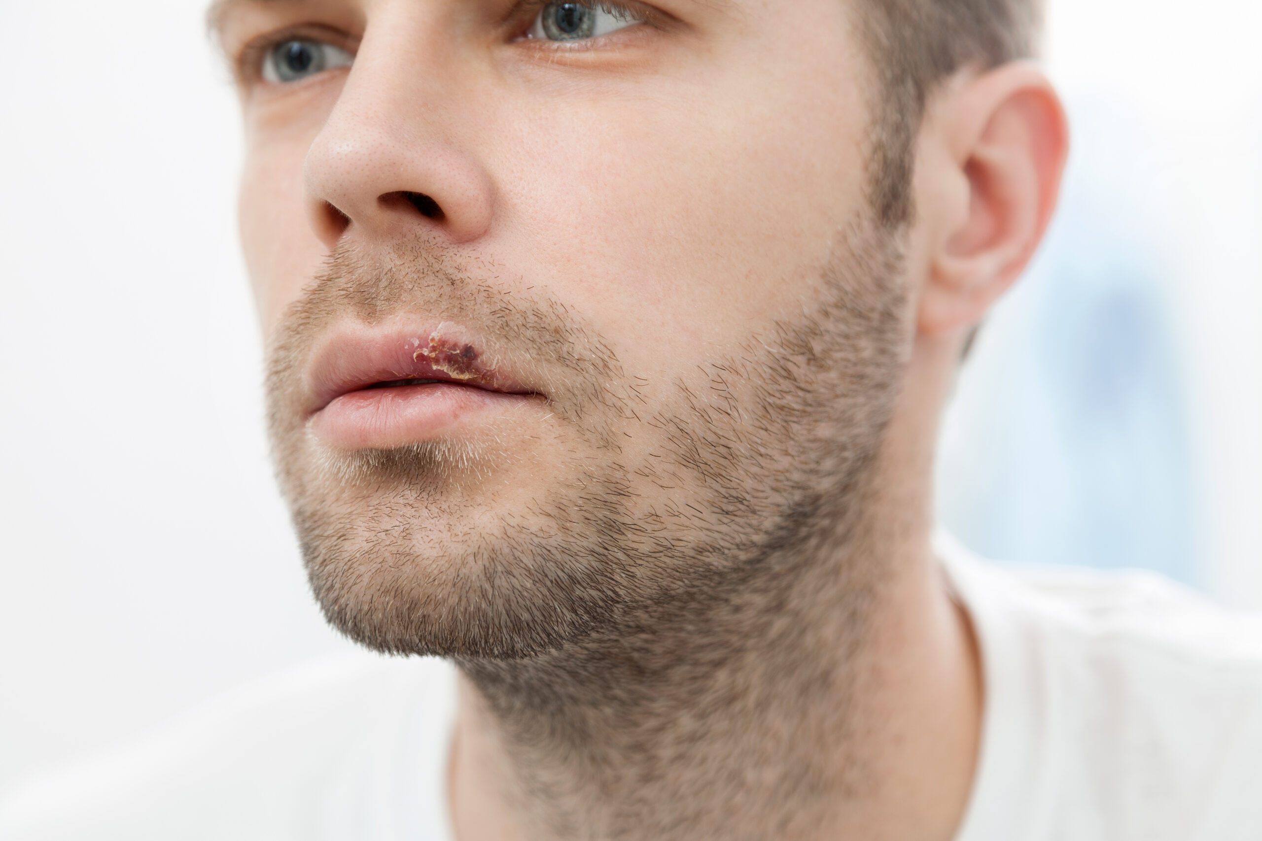 Young man suffering from herpes on his mouth