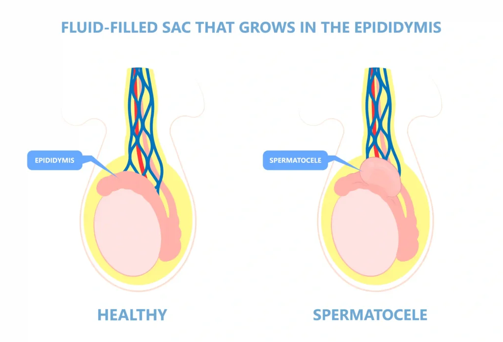 Epididymal cysts and their treatment options