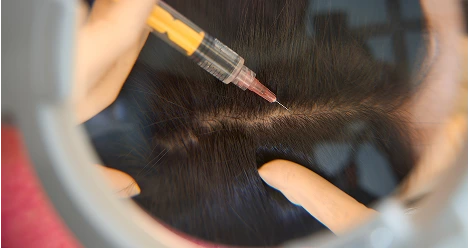 Scalp injection treatment view